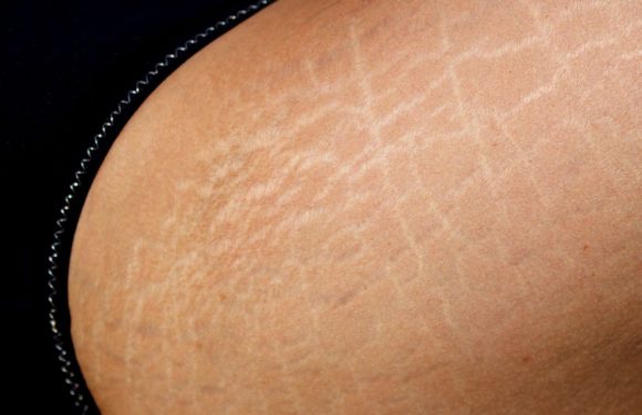 7 solutions naturelles pour en finir avec les vergetures